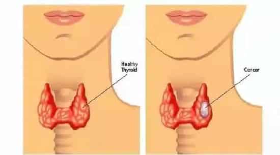 乳房结节怎么散结最快,乳腺结节吃什么散结快?乳腺结节有什么好的治疗方法吗？