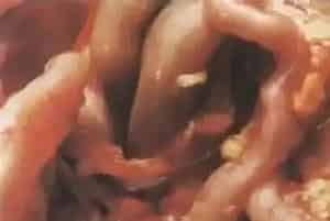 鸡结核病防治方法